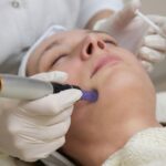 nefits of Skin Needling