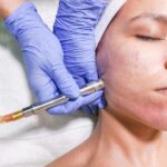 Benefits of Microdermabrasion Explained