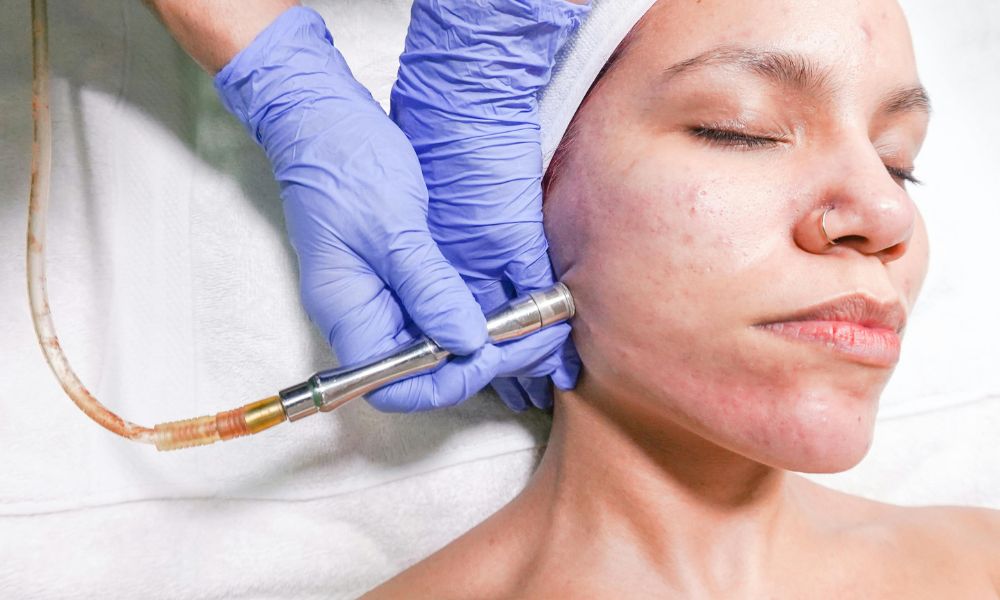 Bye-Bye Dull Skin: Benefits of Microdermabrasion Explained